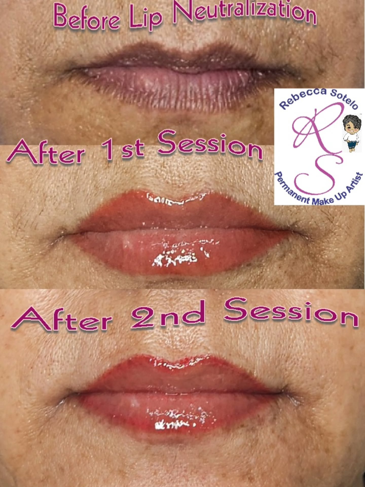 Lip neutralization before, first and second session